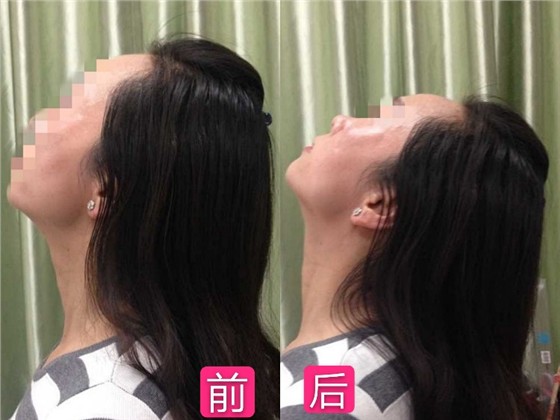 理疗前后对比