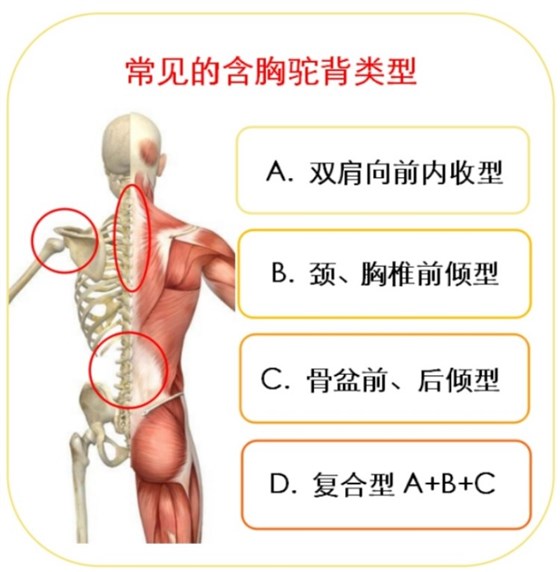 含胸驼背常见类型 