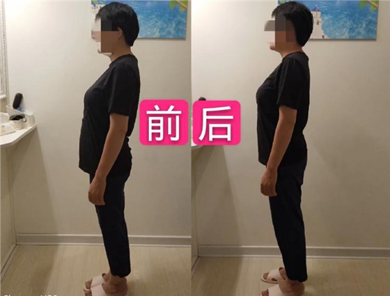 日式含胸驼背矫正