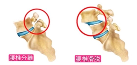 腰椎滑脱、腰椎分离