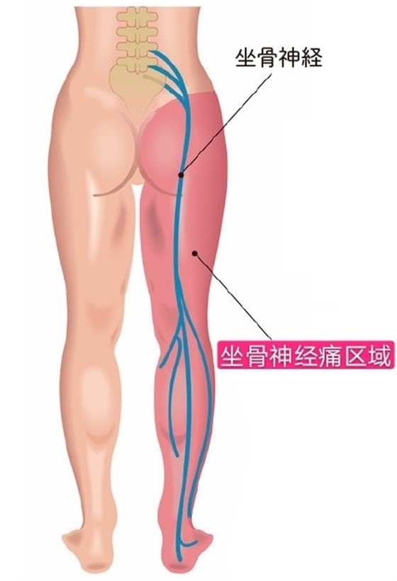 坐骨神经痛