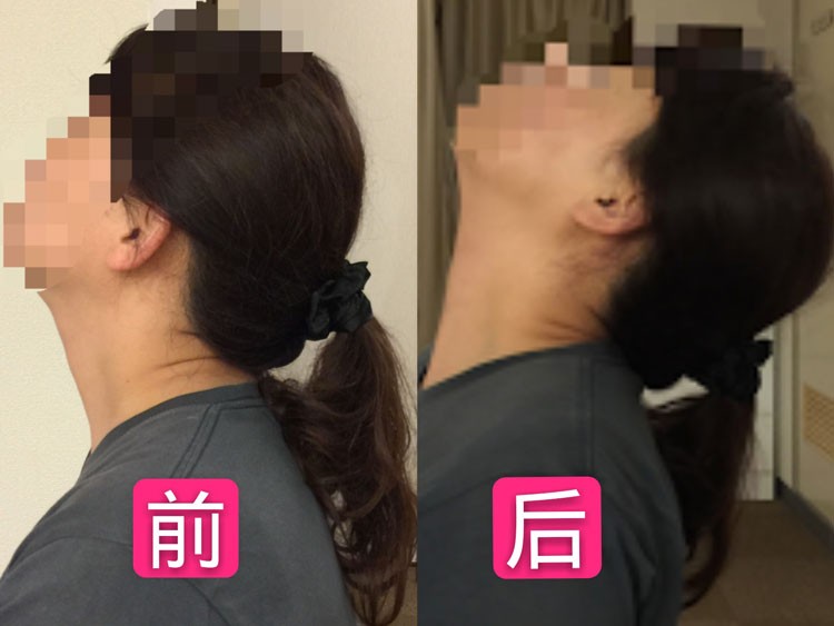 日式关联痛技法保健按摩案例