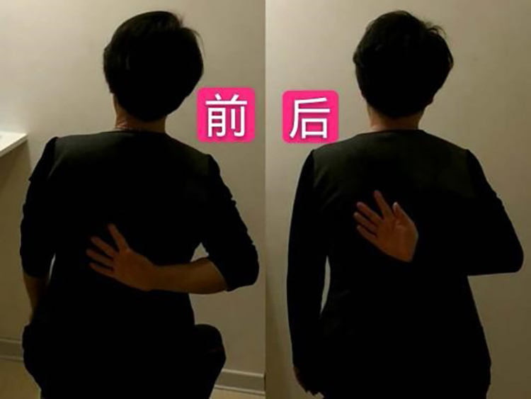 肩周炎理疗前后对比