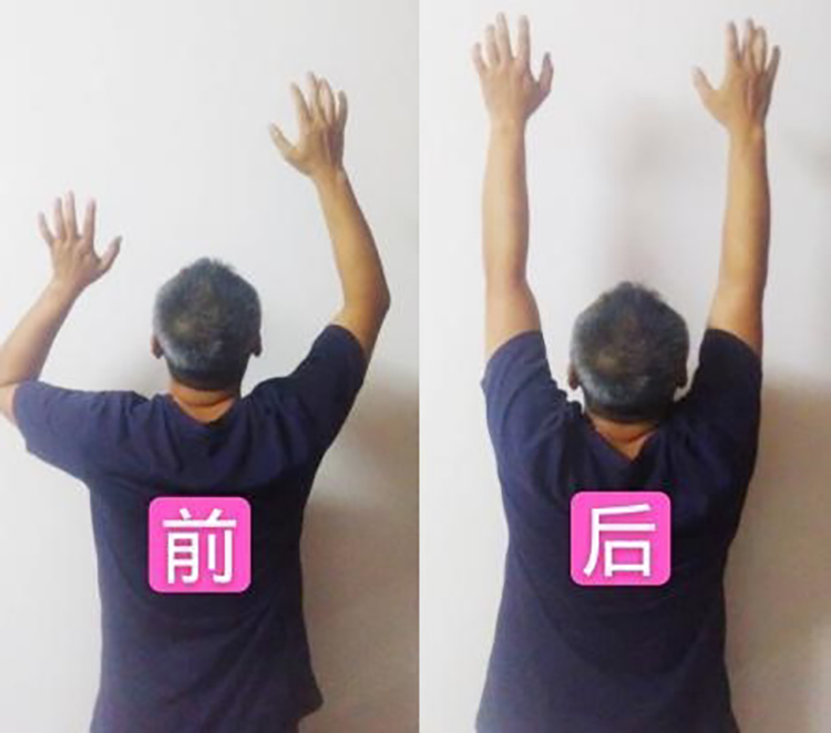 肩周炎理疗前后对比